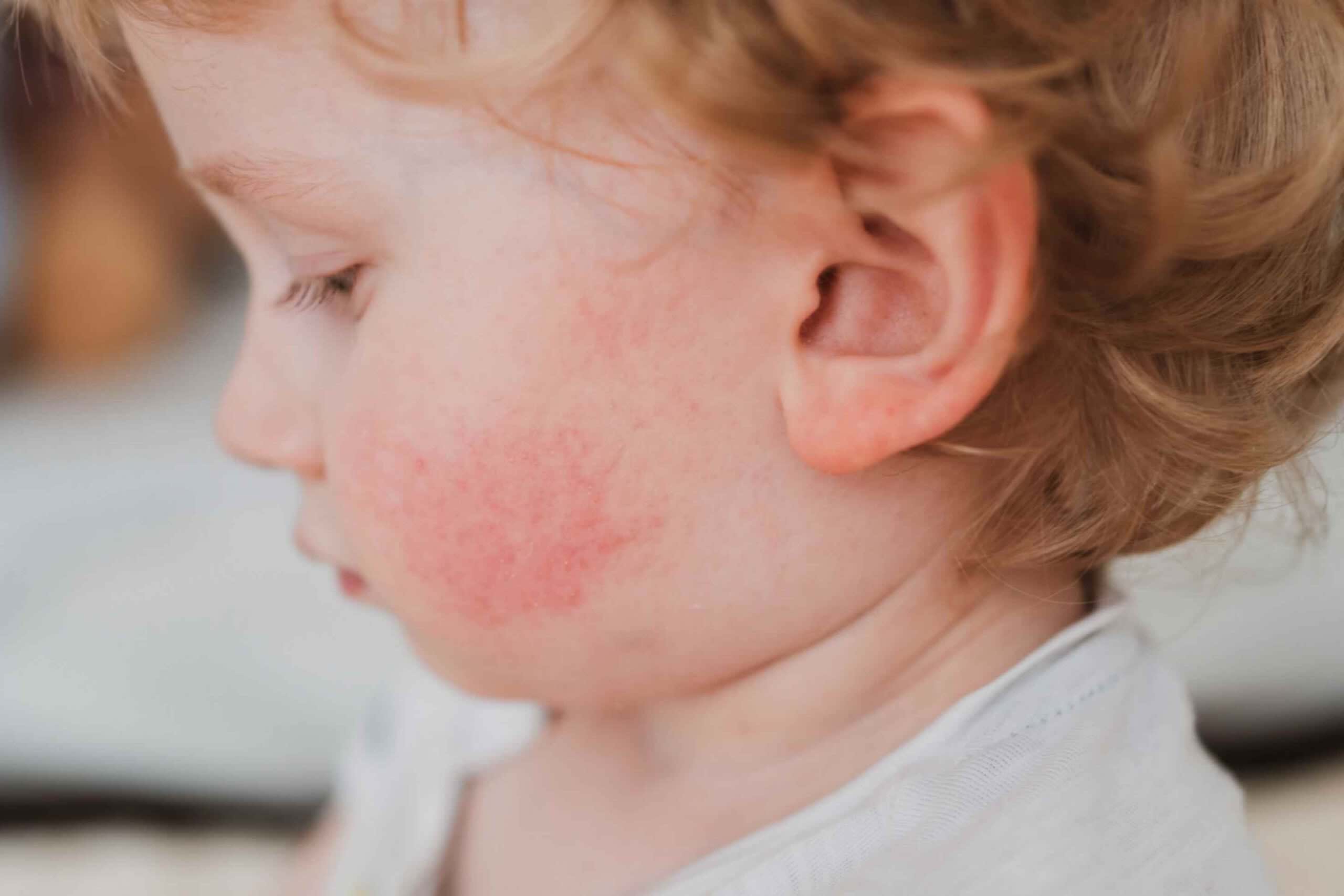 26 Fakta Om Impetigo