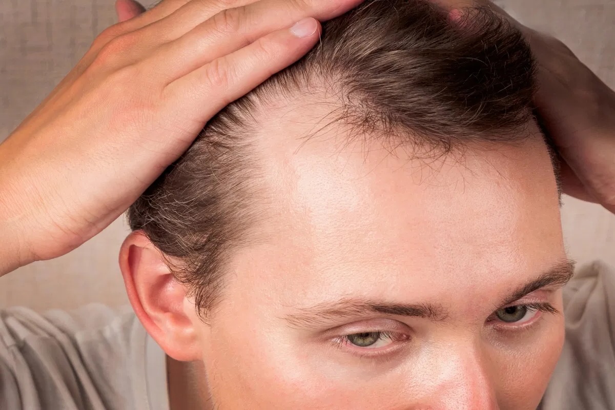 36 Fakta Om Alopeci
