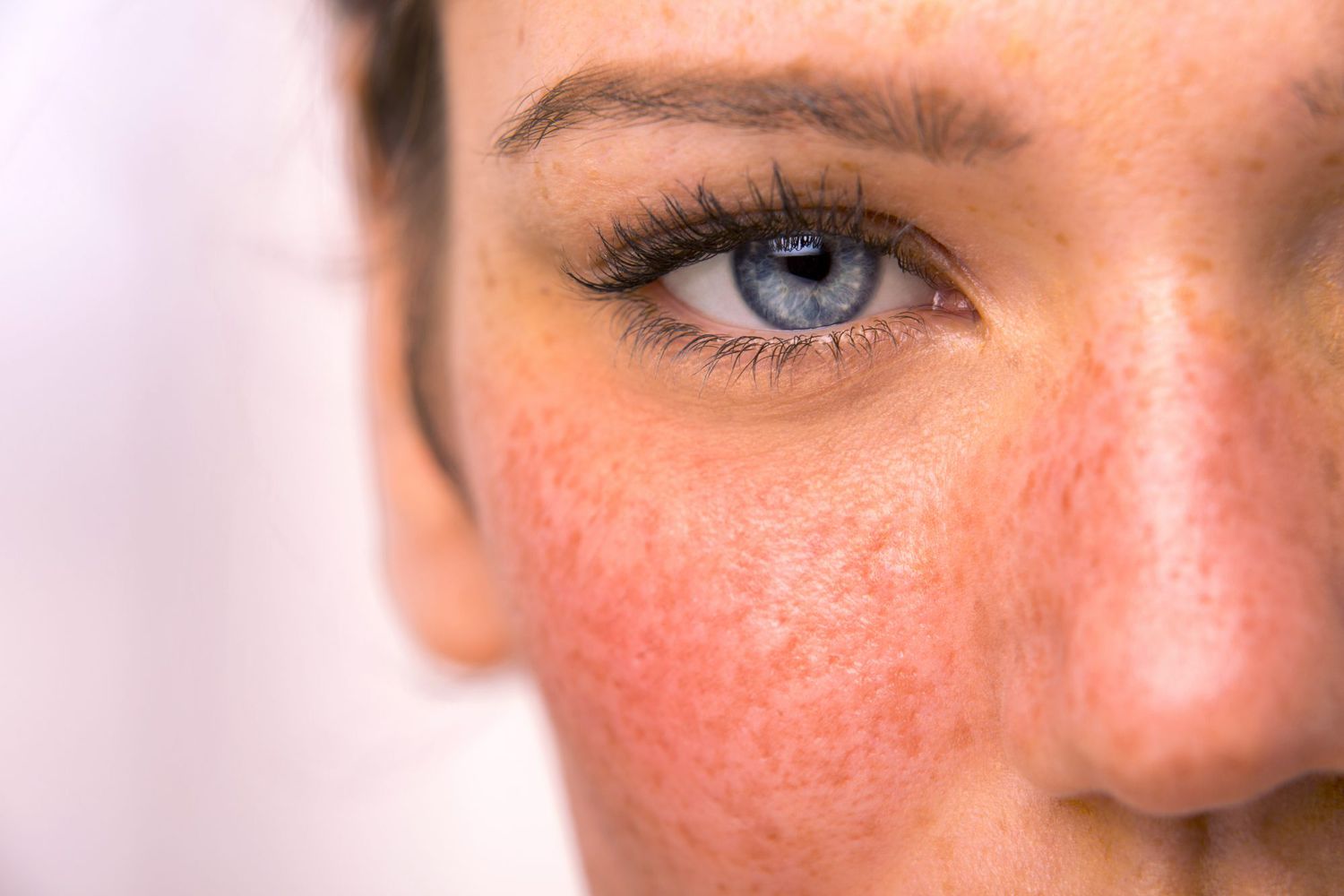 37 Fakta Om Rosacea
