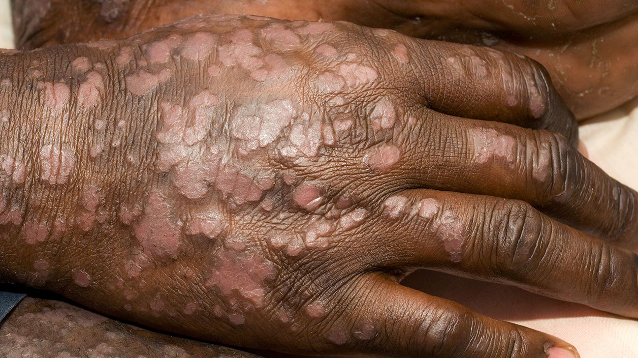 40 Fakta Om Psoriasis